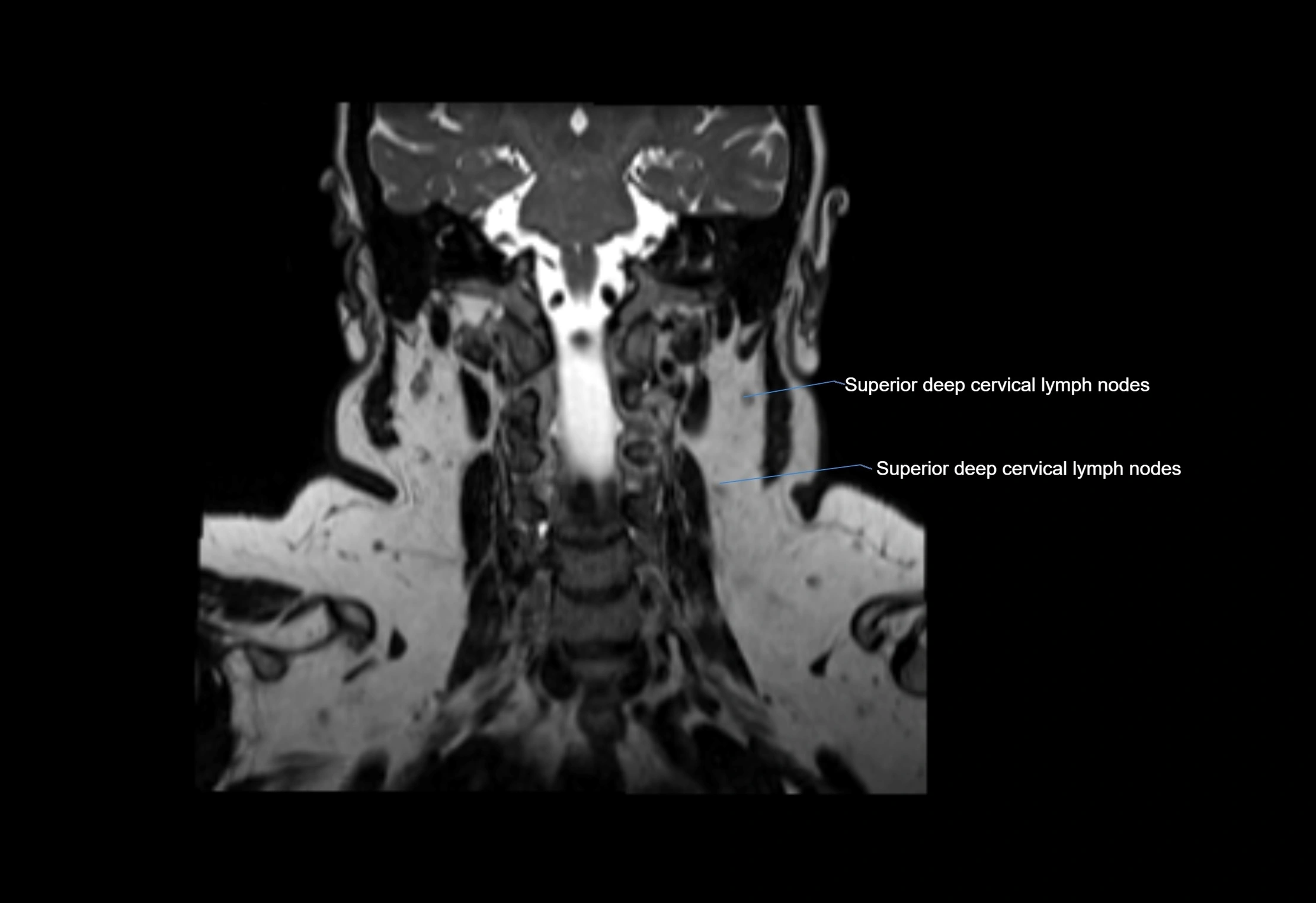 Neck coronal lymph node cross sectional MRI anatomy 3T MRI  image-img-00001-00027.webp